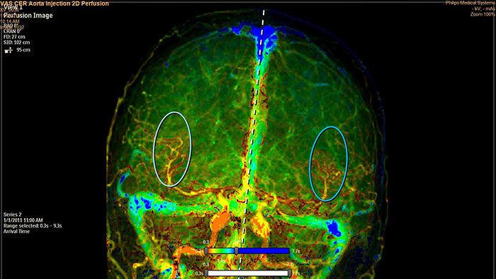 Perfus&atilde;o de tecido SmartPerfusion com base em angiografia digital