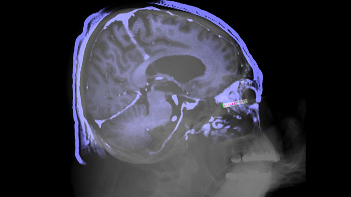 Orienta&ccedil;&atilde;o da agulha de imagens 3D XperGuide