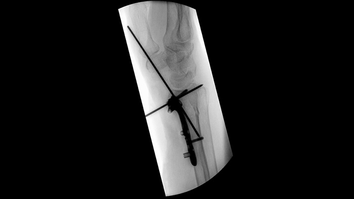 Colima&ccedil;&atilde;o assim&eacute;trica