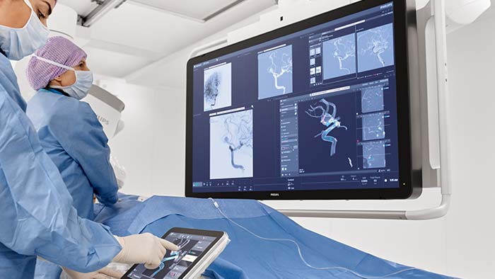 Tratamento do aneurisma cerebral