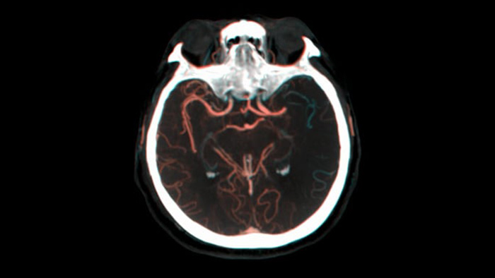 Visualiza&ccedil;&atilde;o de enchimento colateral