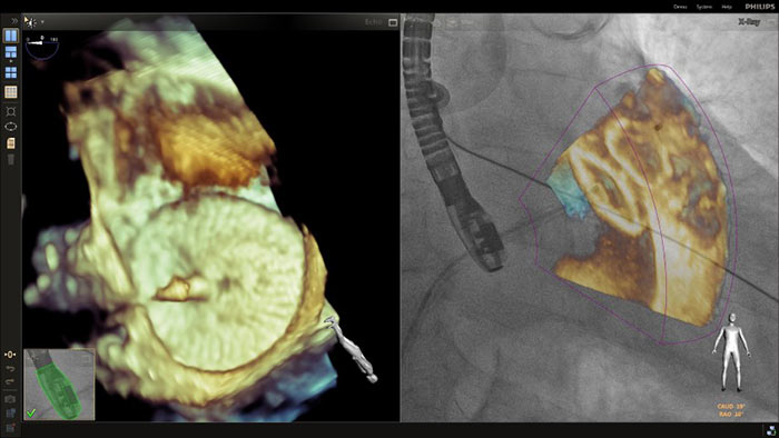 Sobreposi&ccedil;&atilde;o de zoom 3D num procedimento de fecho de LAA