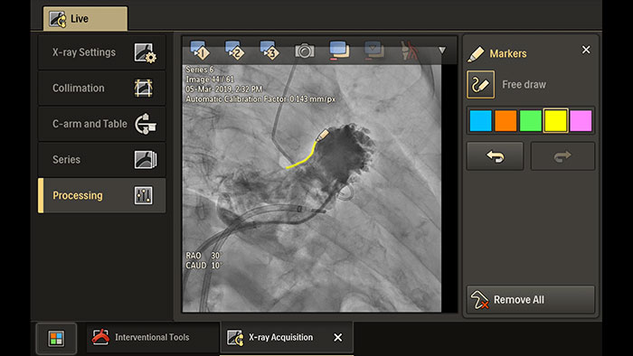 Solu&ccedil;&otilde;es de fluxo de trabalho Azurion