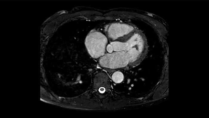 3D bTFE Cora&ccedil;&atilde;o inteiro