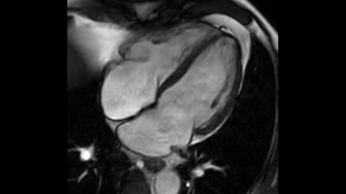 bTFE Compressed SENSE de 4 c&acirc;maras