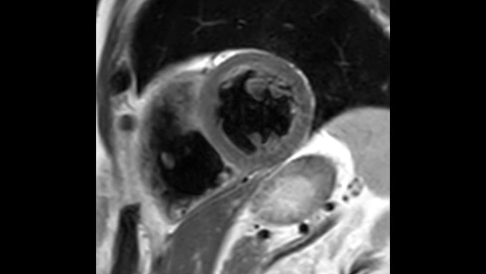 T2w TSE Compressed SENSE de sangue escuro