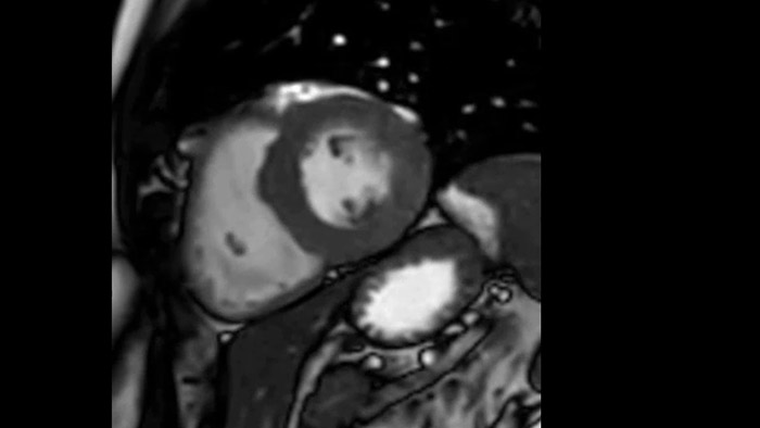 Redu&ccedil;&atilde;o de suspens&otilde;es da respira&ccedil;&atilde;o de at&eacute; 40%