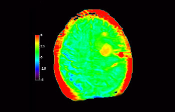 C&eacute;rebro com glioblastoma