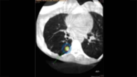 um grande plano de uma radiografia do t&oacute;rax de uma pessoa