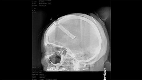 um raio-x de um cr&acirc;nio