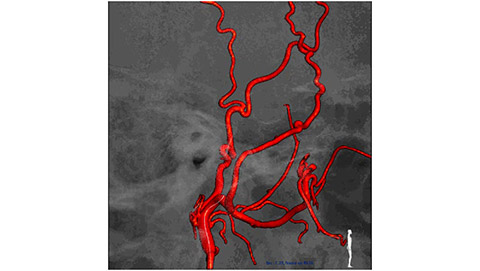 um grande plano de uma tomografia computorizada de um vaso sangu&iacute;neo