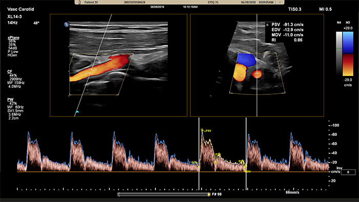 Exemplo de uma imagem recuperada com a ecografia vascular e Doppler xPlane da Philips