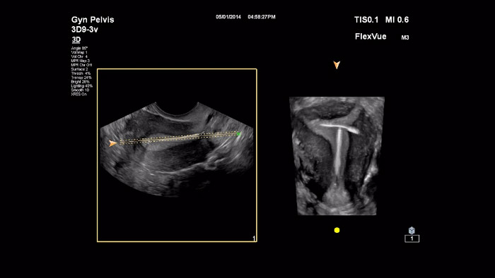 Imagem em miniatura do v&iacute;deo Flexvue