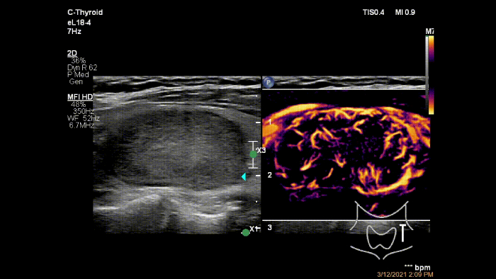 Epiq eL18 4 C thyroid MFI