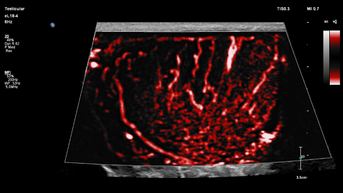 Epiq eL18 4 testicle MFI blend