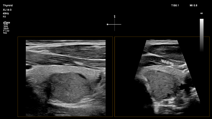 Epiq xL14 3 thyroid xPlane