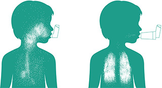 &iquest;Qu&eacute; es el asma?