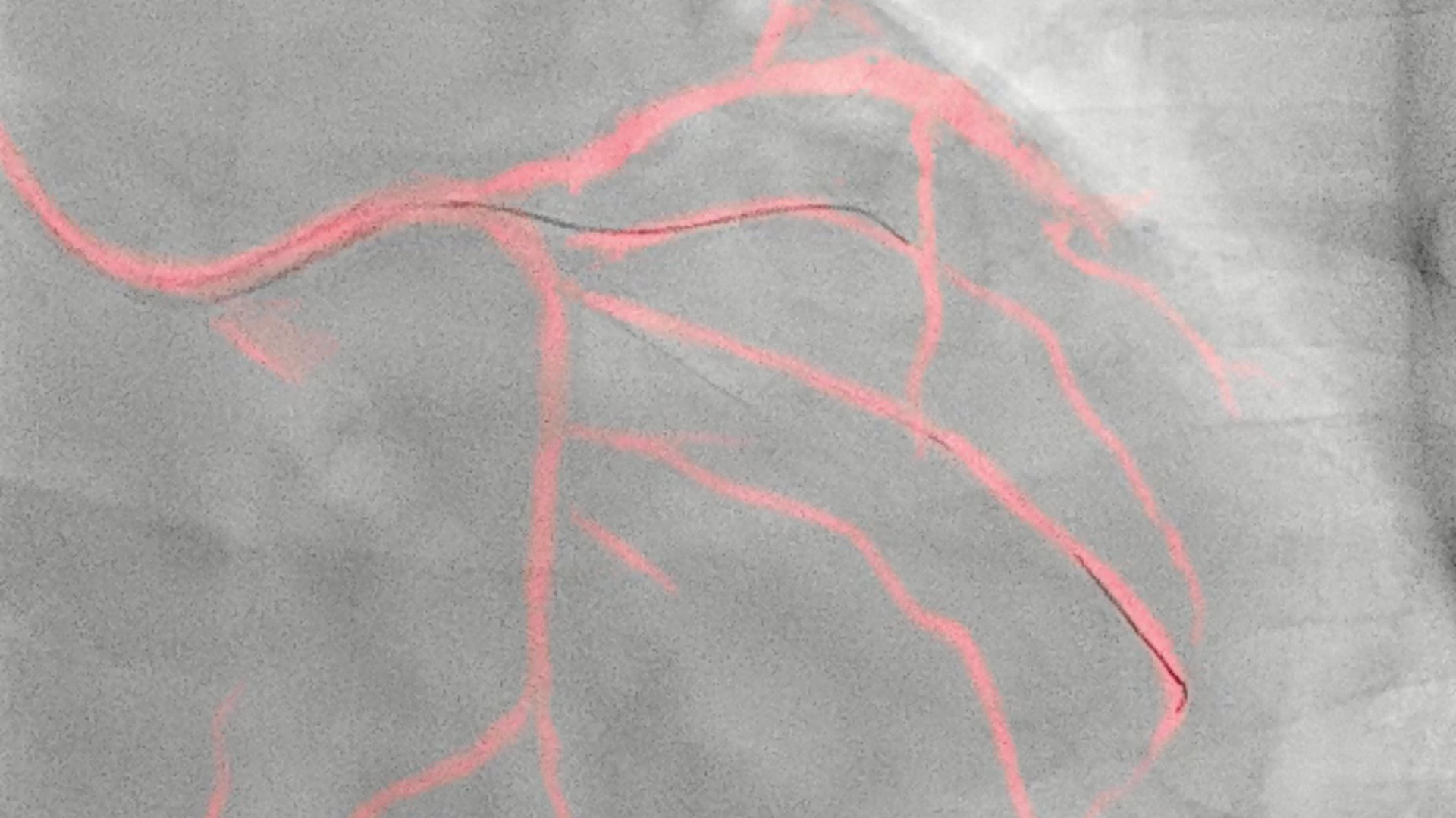 Philips&rsquo; image-guided navigation increases safety during coronary interventions and reduces the use of contrast media by an average of 28.8%